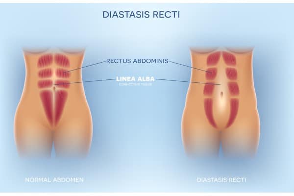 What Non-Surgical Options Are Available for Diastasis Recti Birchfield?