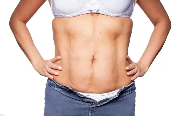 sagging skin on woman's stomach after weight loss injections Birchfield
