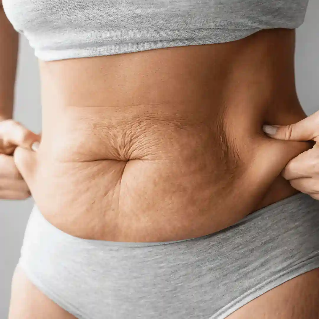 Is It Normal to Have Loose Skin After Pregnancy Birchfield?